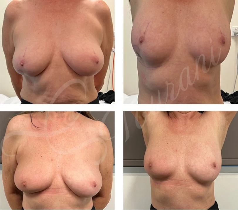 AICAP perforator flap, partial breast reconstruction, Oncoplastic breast cancer surgery, lumpectomy.
