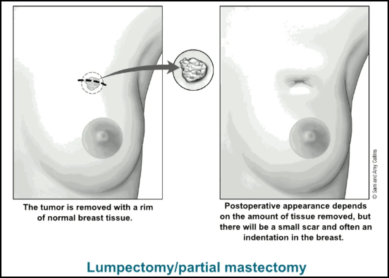 Lumpectomy breast cancer surgery, indentation, contour defect, partial mastectomy