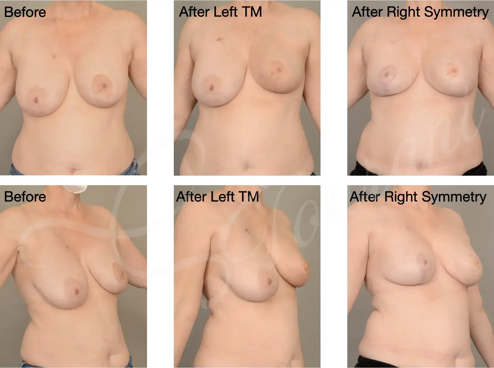 Case 122: Left breast lumpectomy + therapeutic mammoplasty + radiotherapy, followed by right symmetrising reduction. 