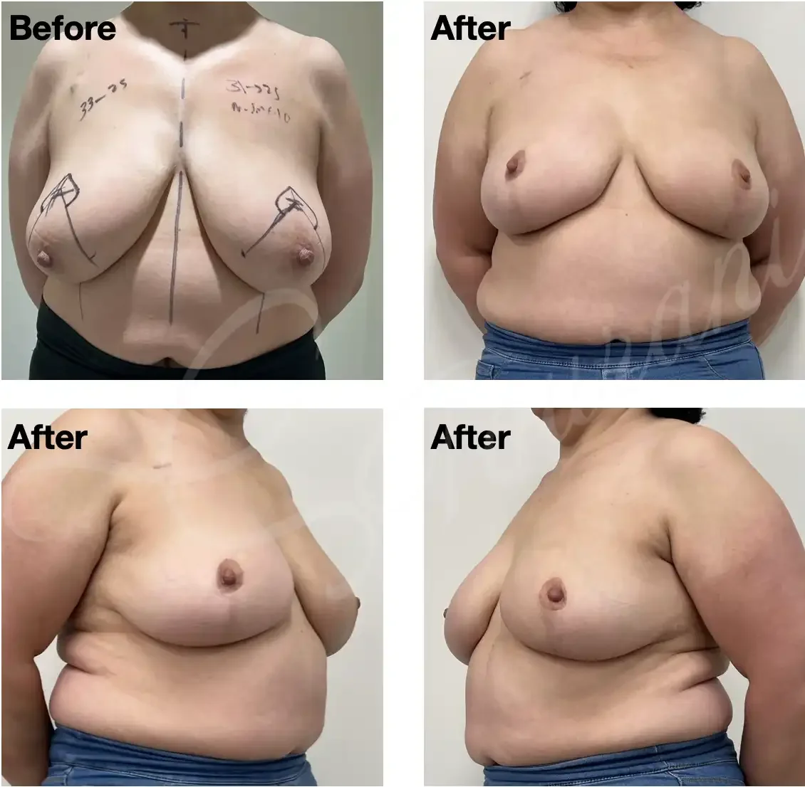Case 115: One year post left breast lumpectomy + therapeutic mammoplasty + simultaneous symmetrising right breast reduction. 