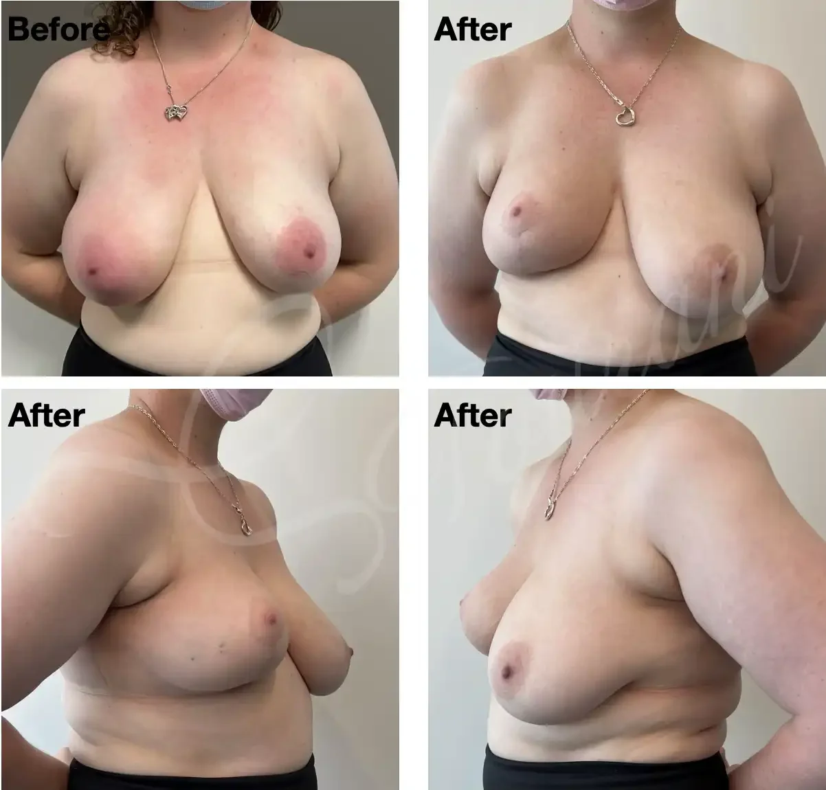 Case 111: 6 months post right breast lumpectomy + therapeutic mammoplasty. Symmetrising left breast reduction can be done at the same time or down the track. 