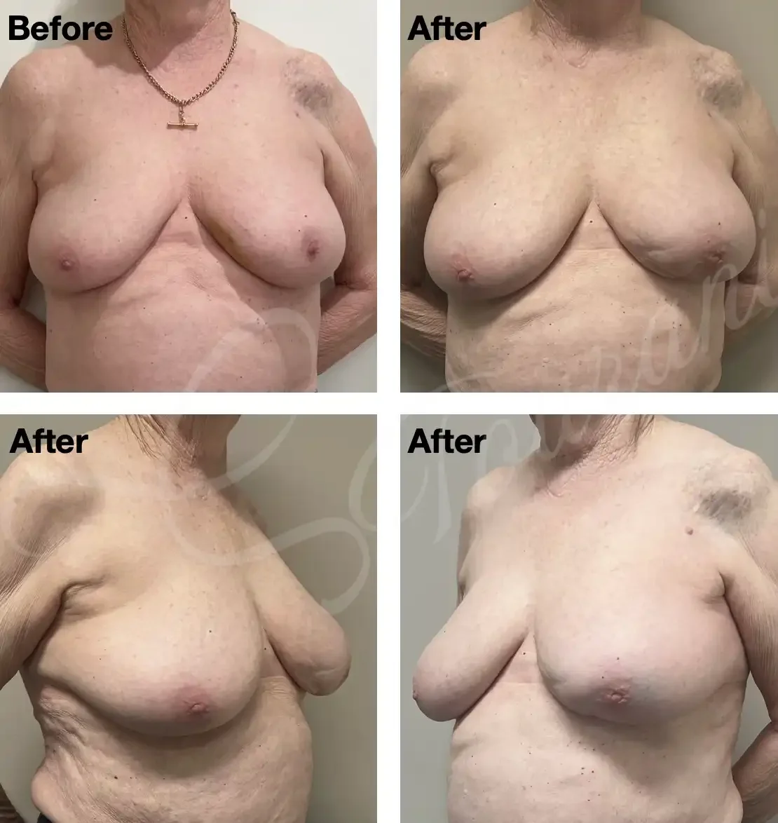 Case 120: One year post left breast lumpectomy + MICAP flap