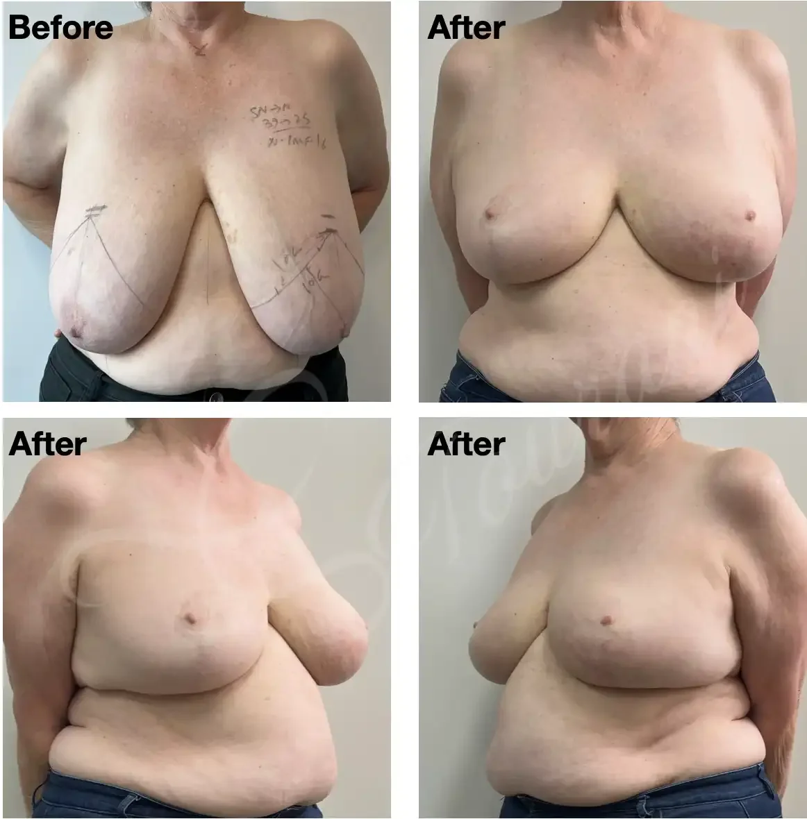 Case 103: 2 years post left breast lumpectomy + therapeutic mammoplasty + simultaneous right symmetrising breast reduction.