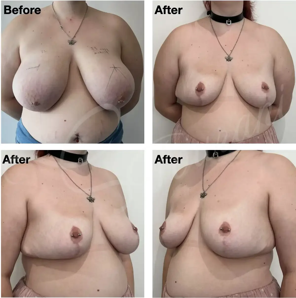 Case #210: One year post bilateral breast reduction. 