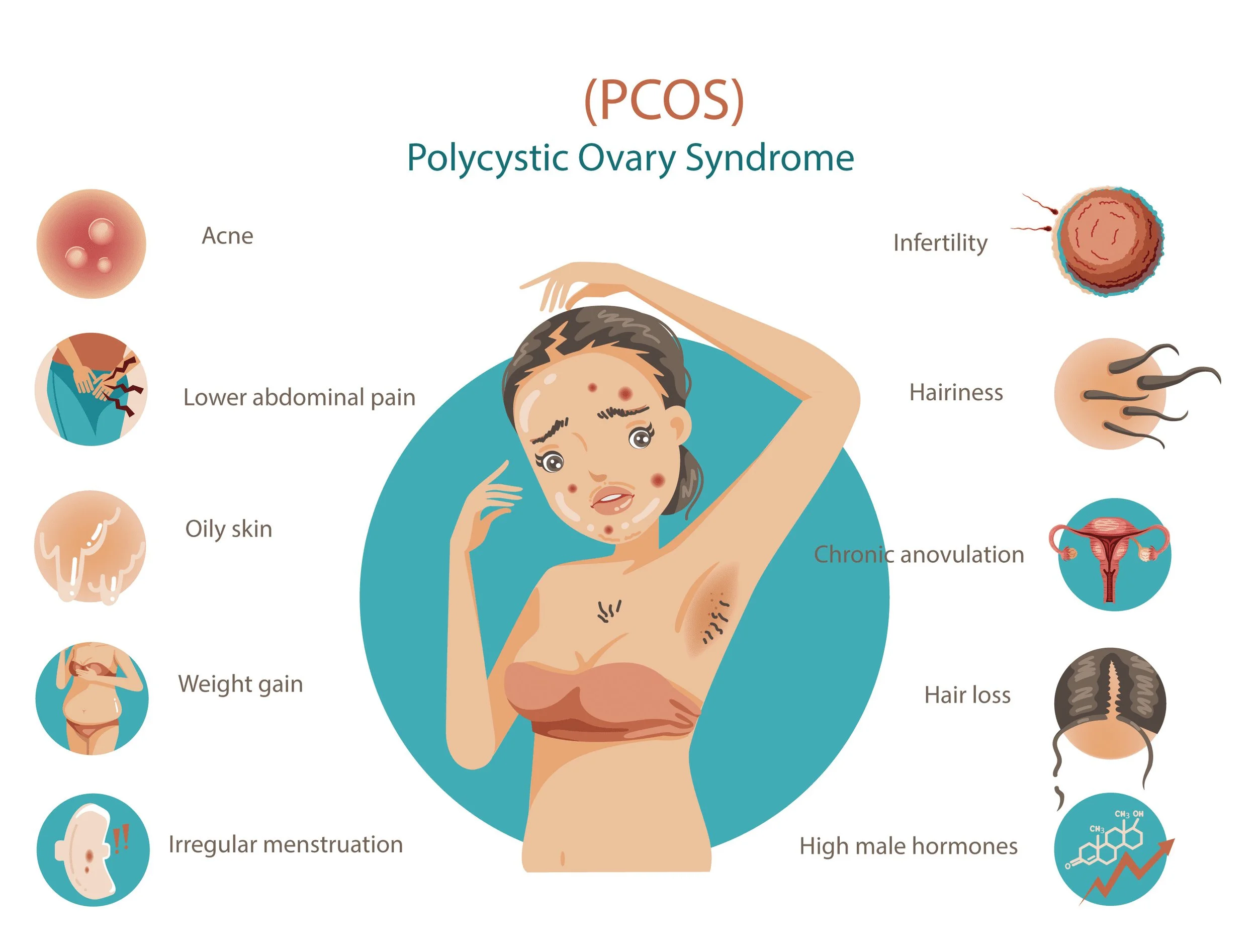 Polycystic Ovary Syndrome Causes Symptoms Management Options In 