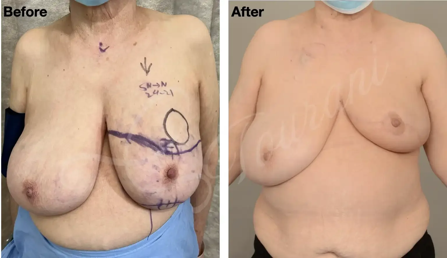 Case 109: One year post left breast lumpectomy for a large upper pole tumour (marked) + melon slice mammoplasty in an elderly diabetic patient. Symmetrising right breast reduction can be performed simultaneously or down the track. 