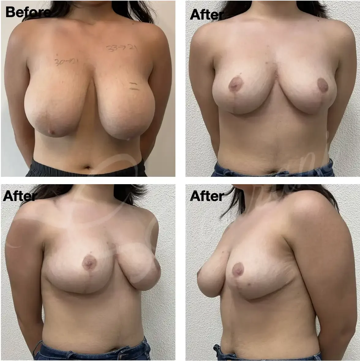 Case #204: One year post bilateral breast reduction. 