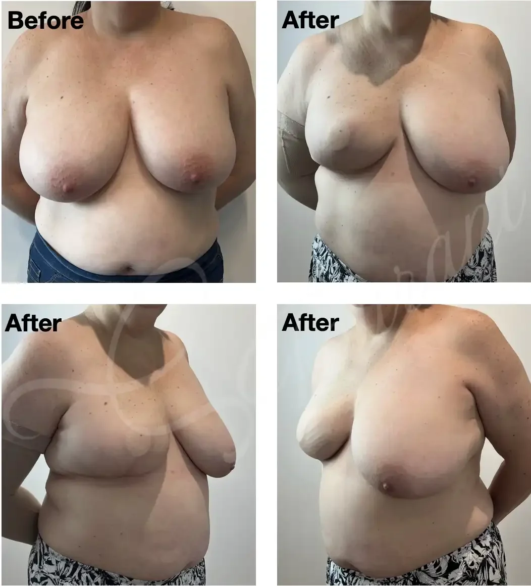 Case #301: Right skin reducing mastectomy and delayed immediate reconstruction with autologous LD flap. Images are 1 year following adjuvant radiotherapy. Awaiting right nipple reconstruction/areolar tattoo and left symmetrising breast reduction. 