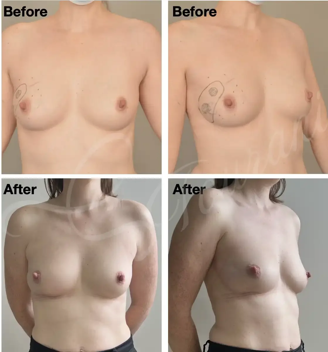 Case 107: One year post right breast lumpectomy for a large multifocal cancer (marked) + LICAP flap. 