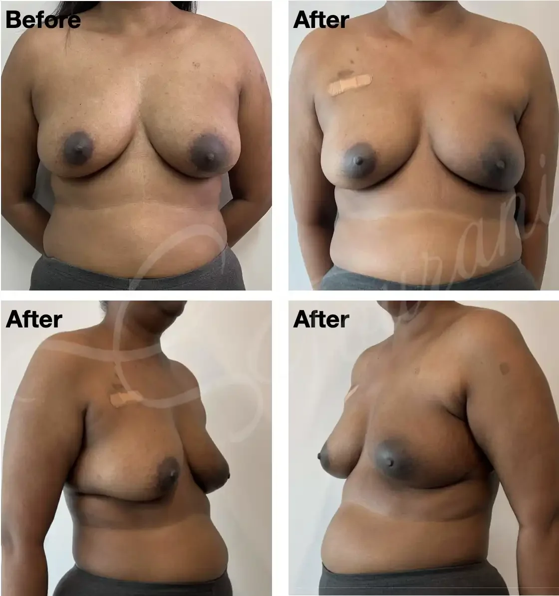 Case 118: One year post left breast lumpectomy + LICAP flap