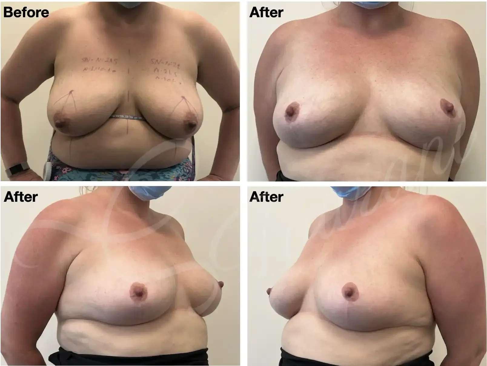 Case #211: One year post bilateral breast lift (mastopexy. 
