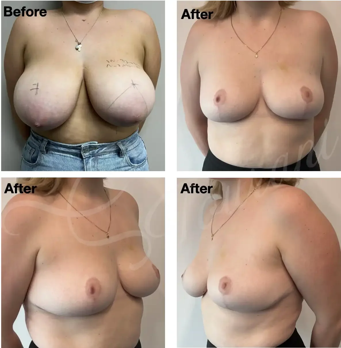 Case #206: One year post bilateral breast reduction. 