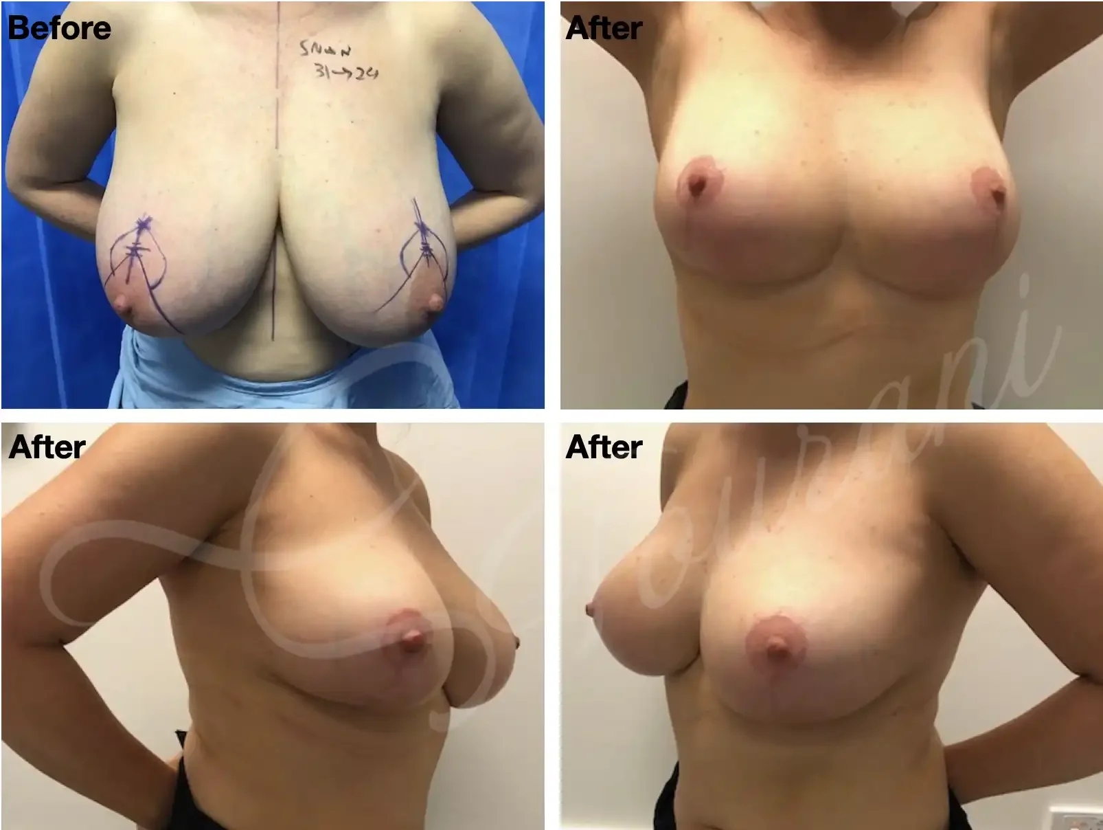 Case #201: One year post bilateral breast reduction. 