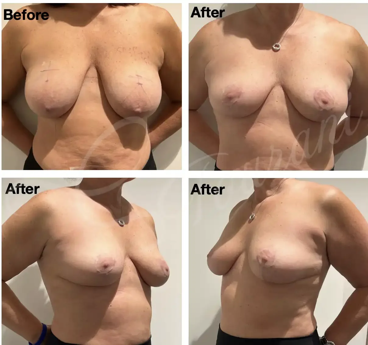 Case #212: One year post bilateral breast lift (mastopexy. 