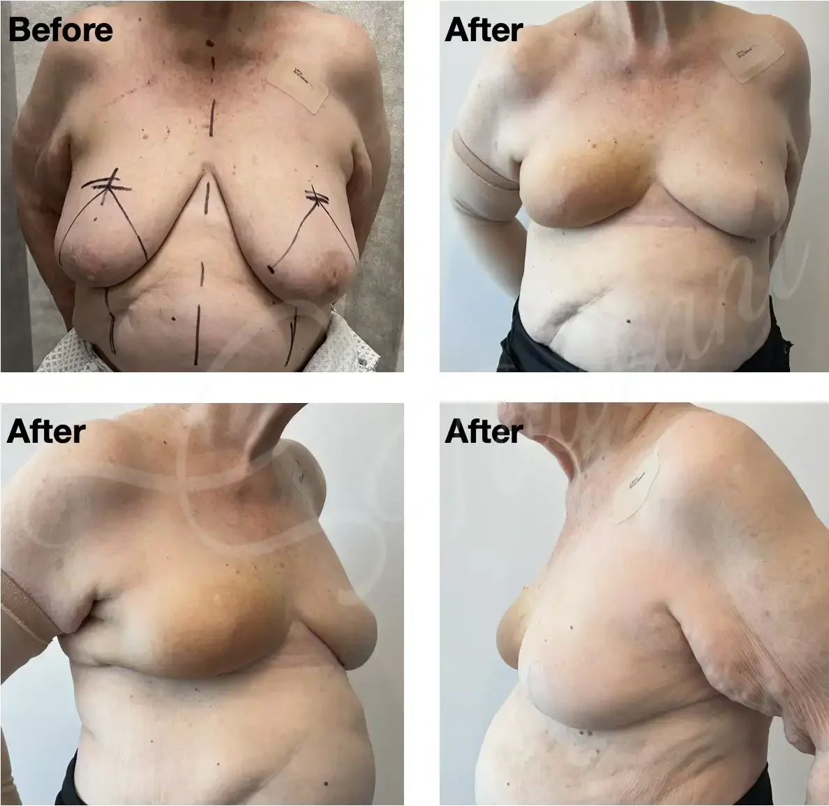 Case 113: 6 months post right breast lumpectomy for a large ulcerated cancer + therapeutic mammoplasty + simultaneous left breast reduction removing the nipple. Radiotherapy skin changes visible on the right side. 
