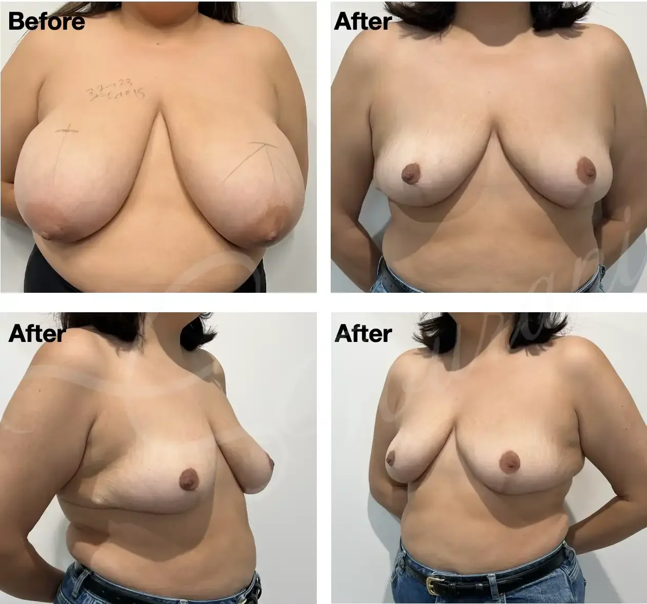 Case #203: One year post bilateral breast reduction. 