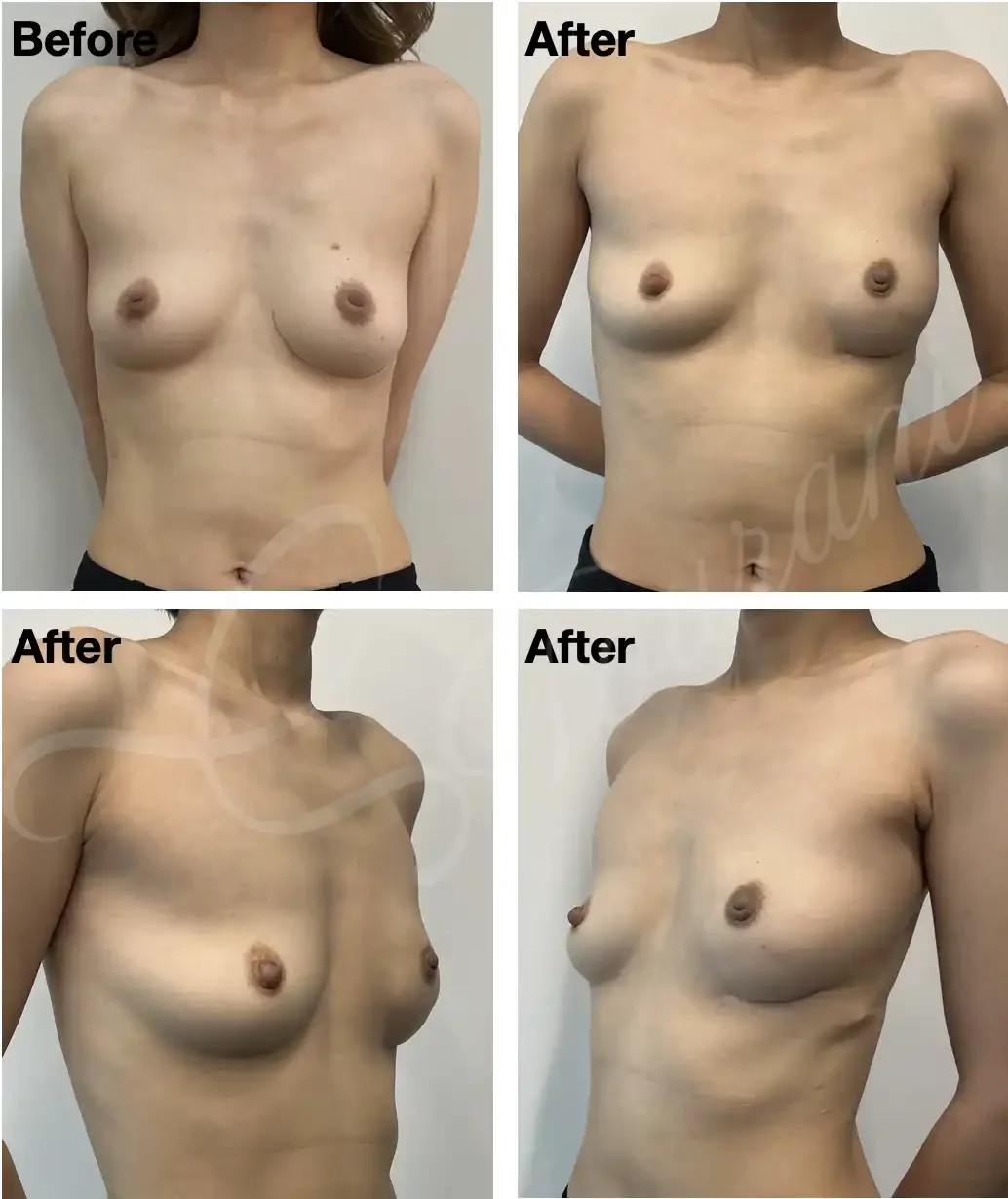 Case #302: Left nipple sparing mastectomy and immediate delayed reconstruction with autologous LD flap. Images are 1 year following adjuvant radiotherapy.