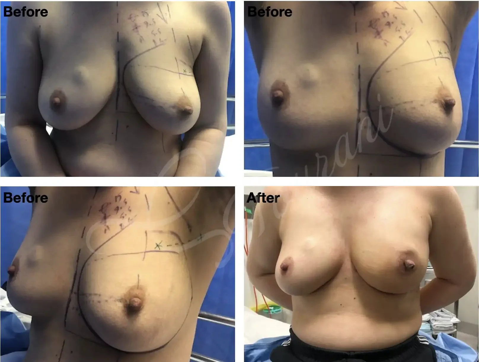 Case #305: 2 weeks post left nipple sparing mastectomy + immediate 1-stage implant reconstruction. 