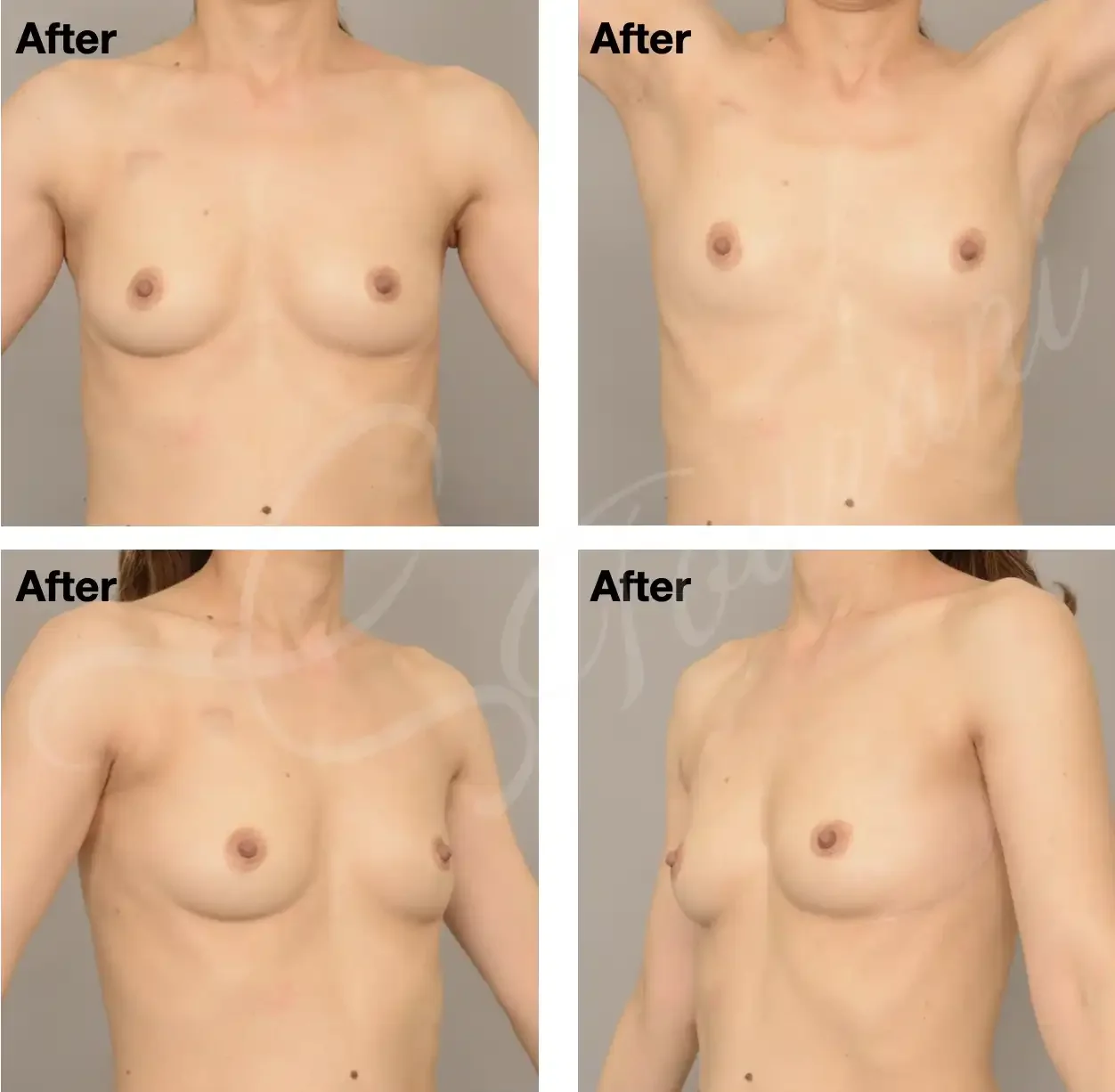 Case 121: One year post left lumpectomy + LICAP flap + adjuvant radiotherapy. 