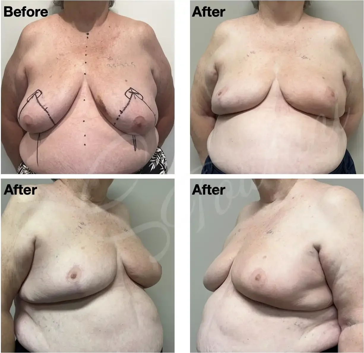 Case 119: 6 months post left breast lumpectomy + therapeutic mammoplasty + simultaneous symmetrising right breast reduction