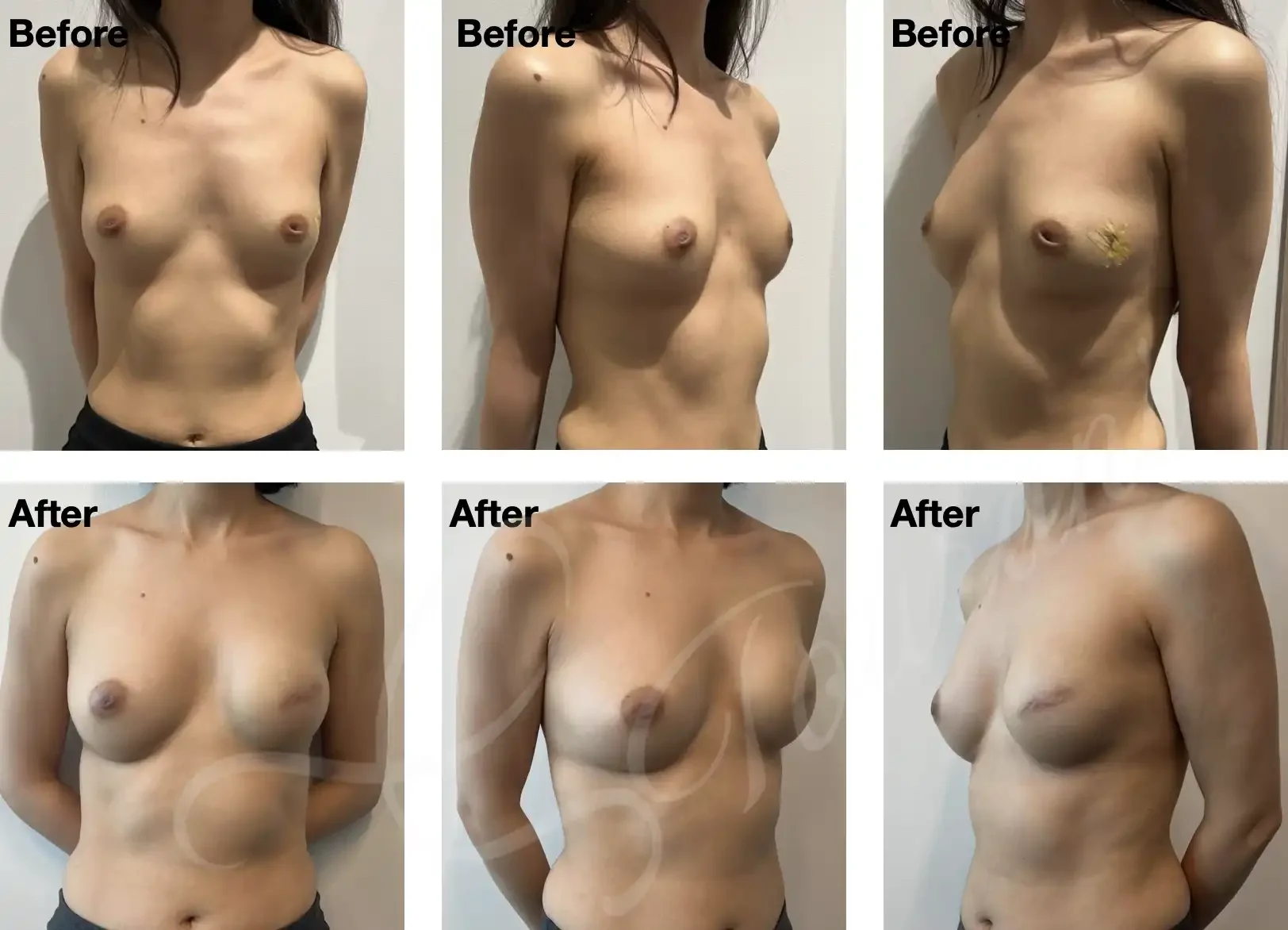 Case #311: One year following left skin sparing mastectomy + immediate 2-stage implant reconstruction. 