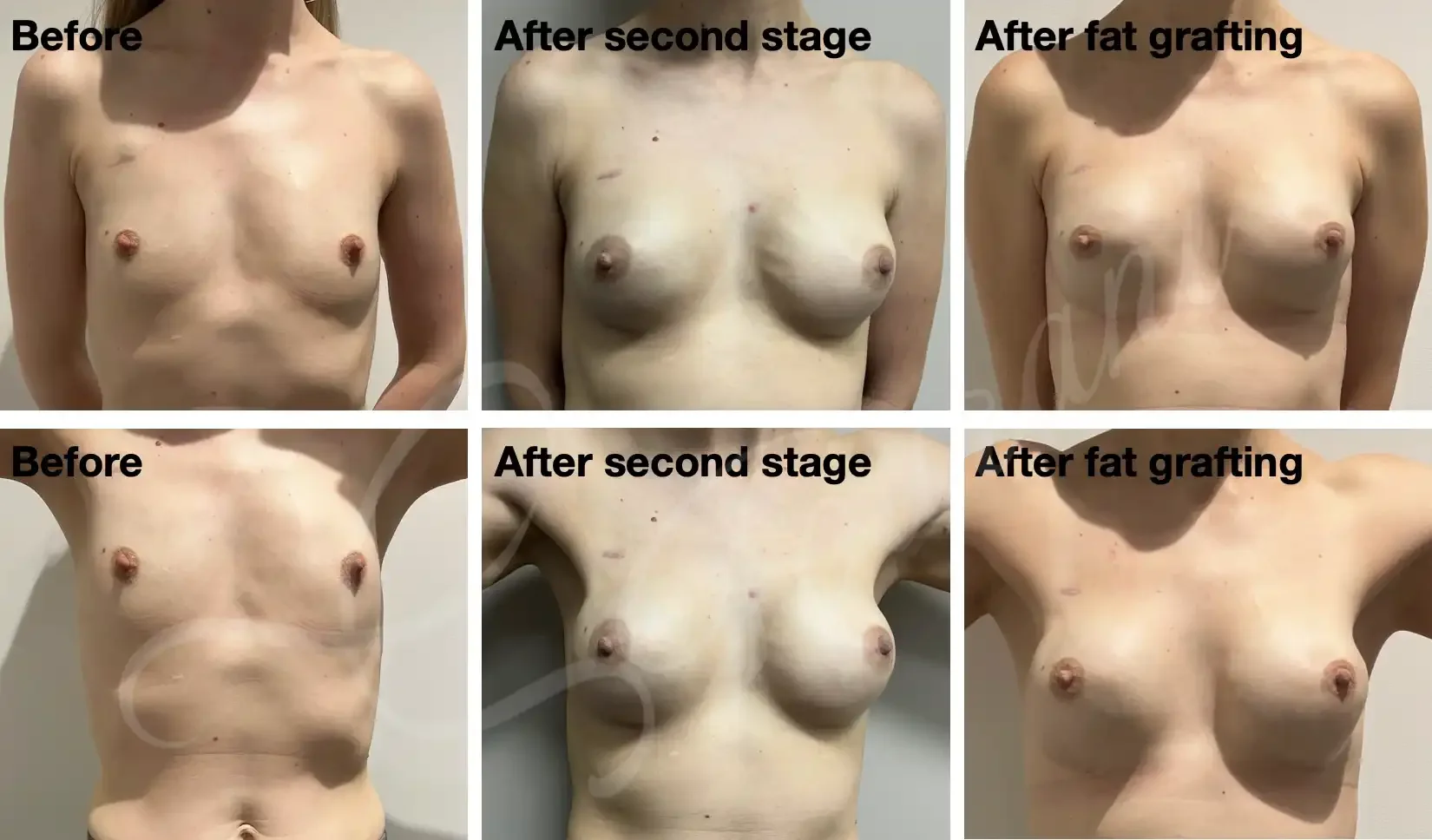 Case #306:  Bilateral nipple sparing mastectomy + implant reconstruction (2-stage left, 1-stage right)  for a triple negative left breast cancer. Final images 1 year post left breast lipomodelling to correct rippling. 