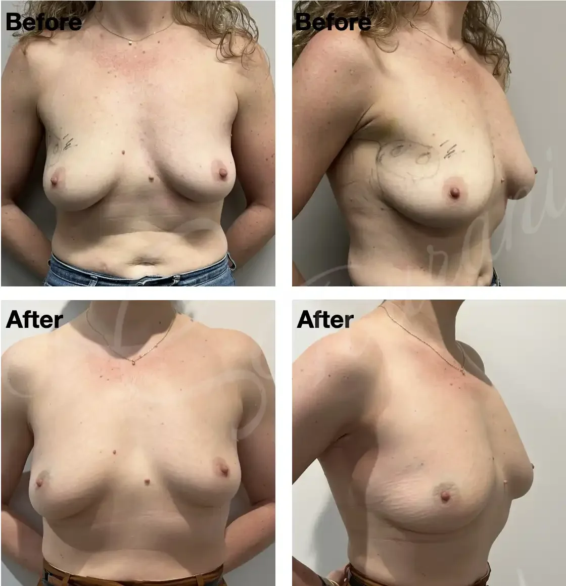 Case 116: One year post left breast lumpectomy for a large multifocal cancer (marked) + LICAP flap