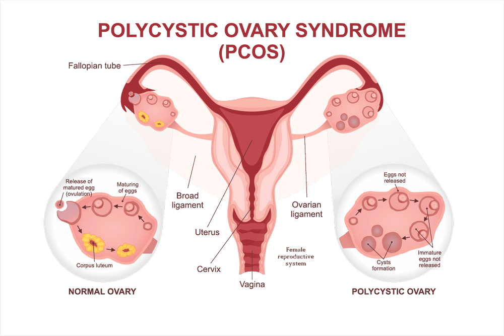 Pcos Explained Polycystic Ovary Syndrome Causes, Symptoms & Management Options in ...