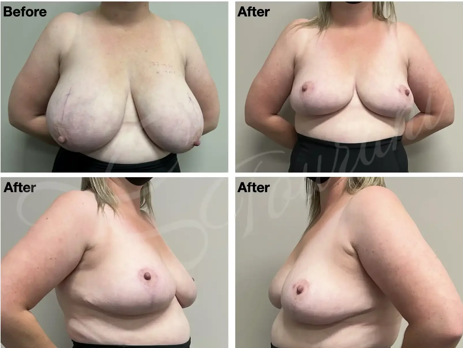 Case #202: One year post bilateral breast reduction.