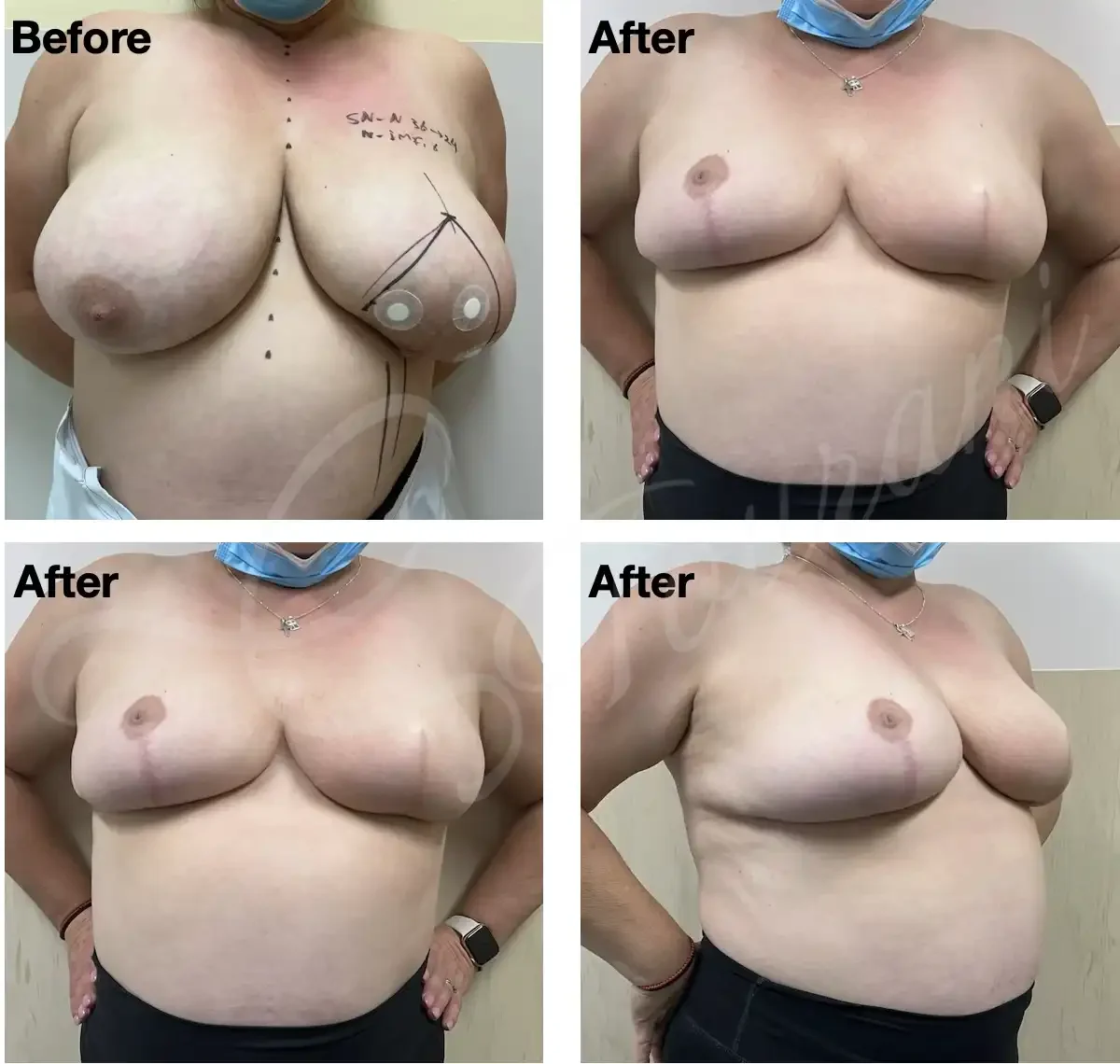 Case 105: 6 months post left breast lumpectomy involving the nipple + therapeutic mammoplasty + symmetrising right breast reduction. Left nipple reconstruction was offered. 