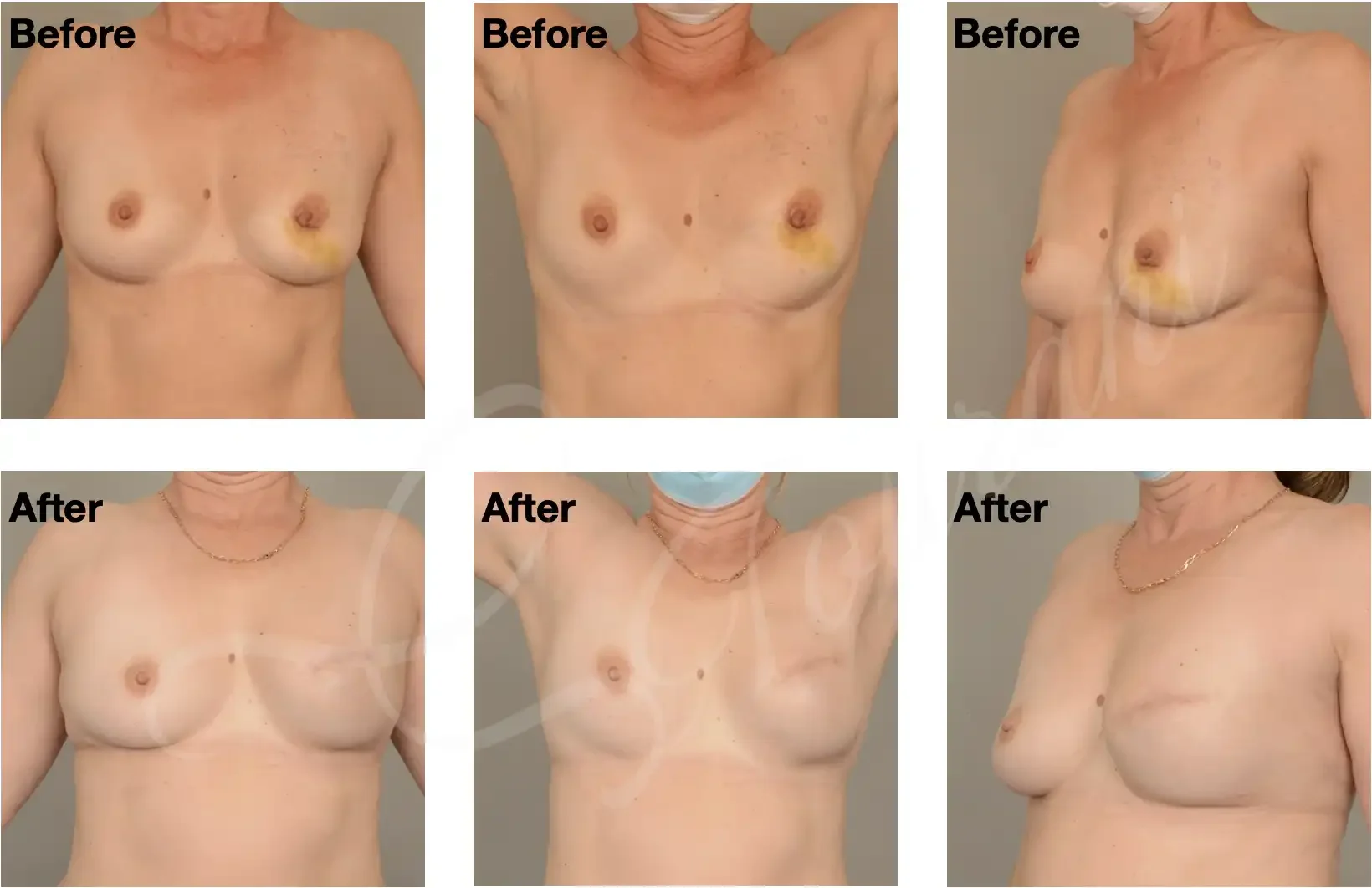 Case #308: 1 year post skin sparing mastectomy + immediate 2-stage implant reconstruction. 