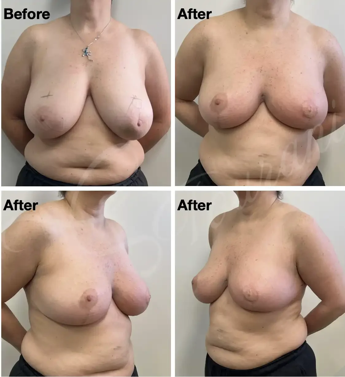 Case 106: One year post left breast lumpectomy including the nipple and areola + left therapeutic mammoplasty+ simultaneous left nipple/areolar reconstruction and right symmetrising breast reduction. 
