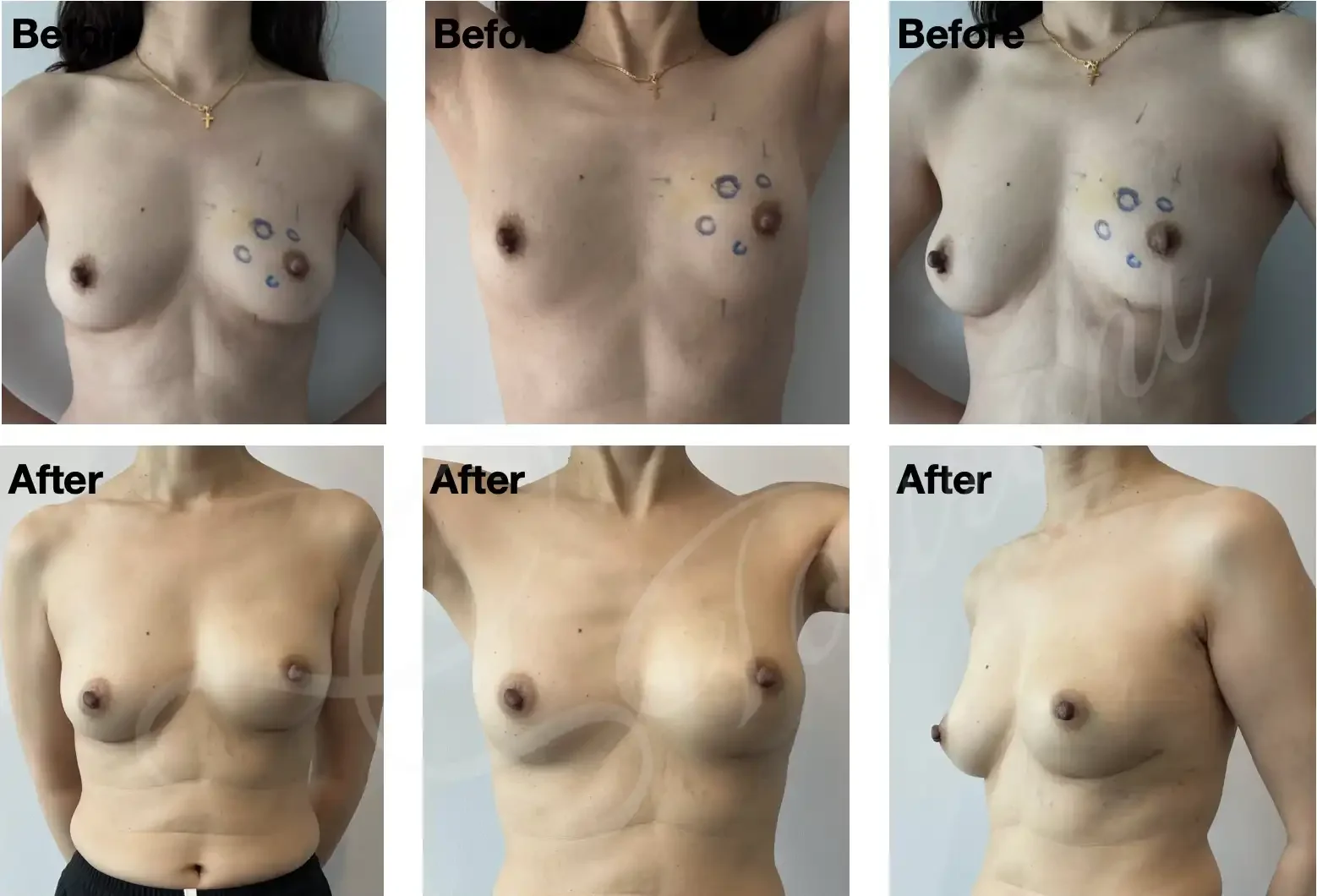 Case #309: Left nipple sparing mastectomy + immediate 1-stage implant reconstruction. Images are 1 year following radiotherapy. 