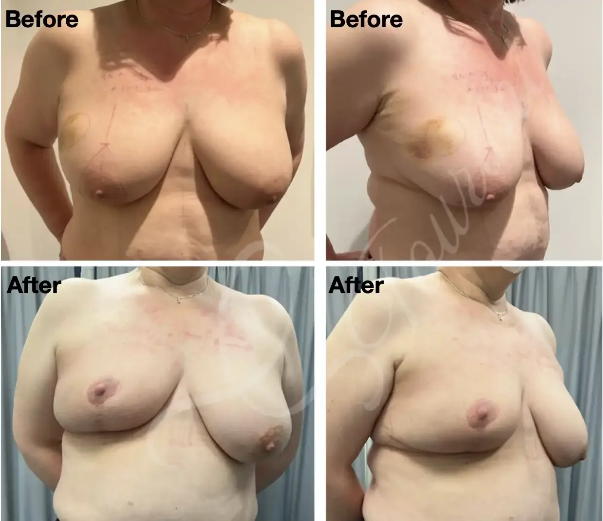 Case 112: One year post right breast lumpectomy for a large multifocal cancer + therapeutic mammoplasty. Symmetrising left breast reduction can be done at the same time or down the track. 