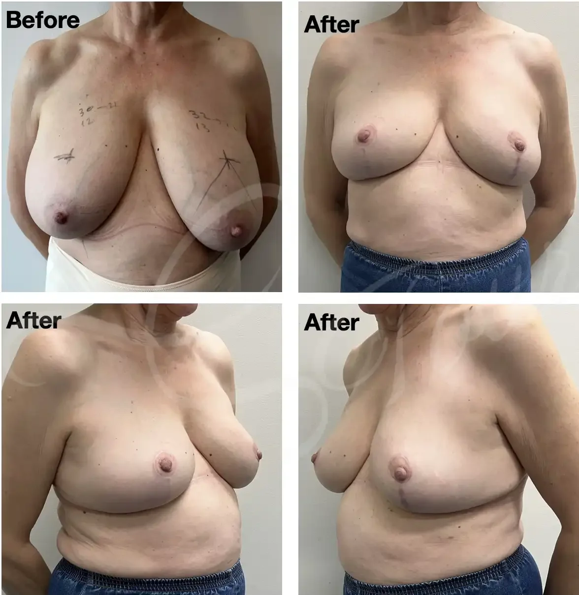 Case #205: One year post bilateral breast reduction. 
