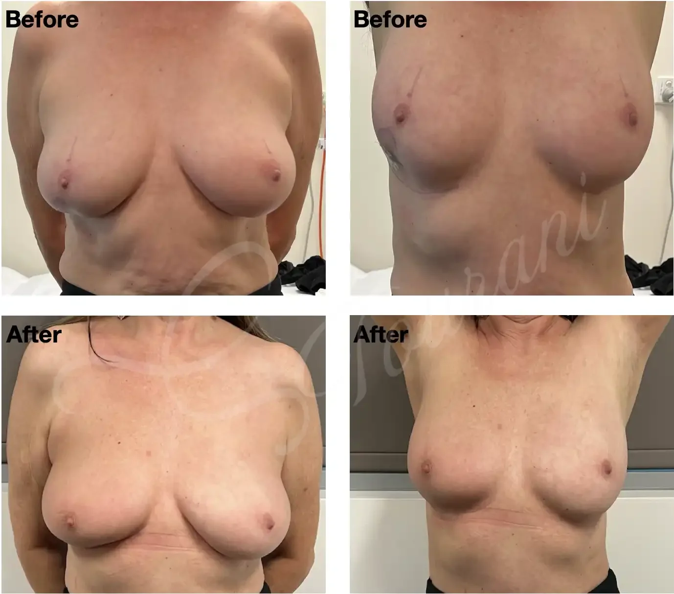 Case 102: 1 year post right breast lower pole lumpectomy + AICAP flap