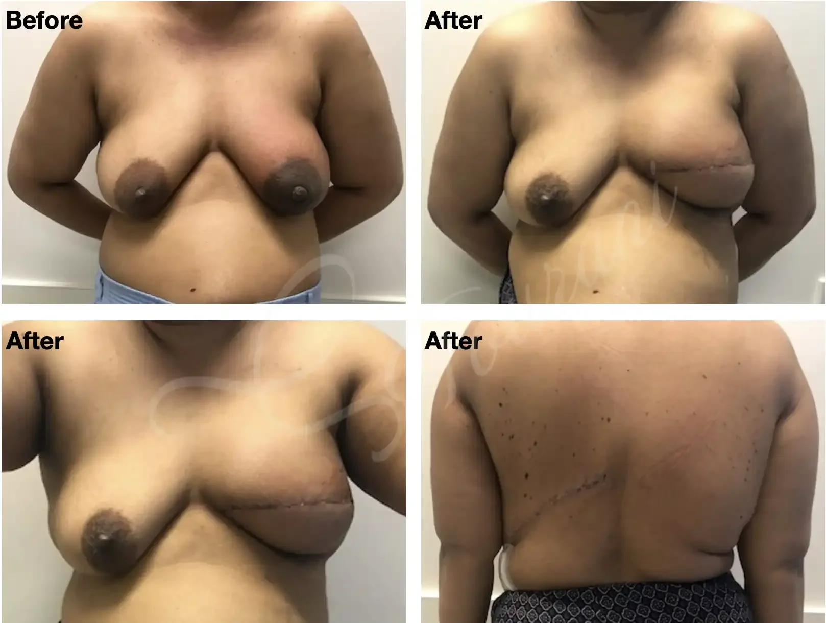 Case #303: Left skin reducing mastectomy + immediate autologous LD flap reconstruction following neoadjuvant chemo and radiotherapy for an inflammatory breast cancer. Images are two weeks following surgery. 