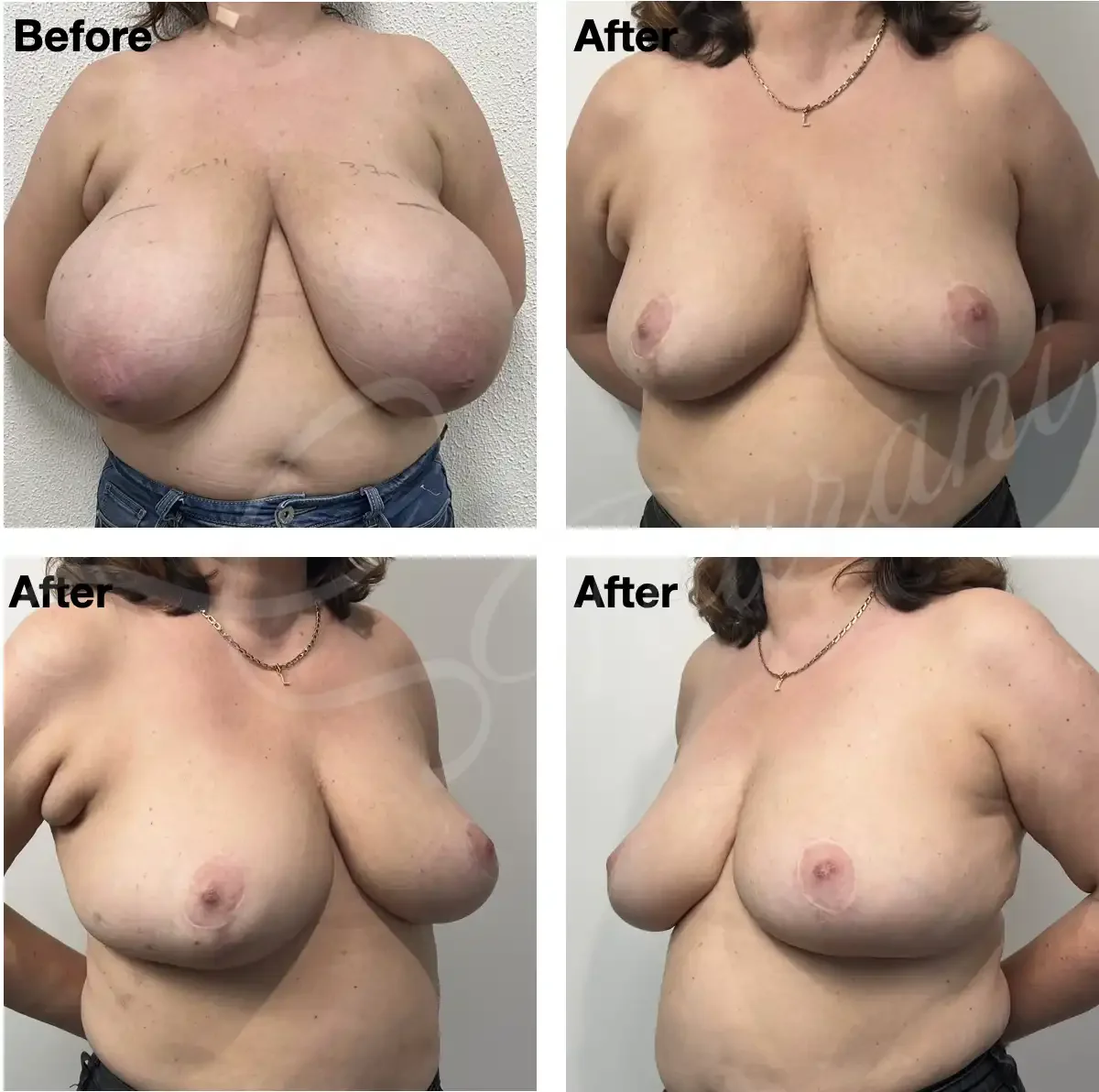 Case #207: One year post bilateral breast reduction. 