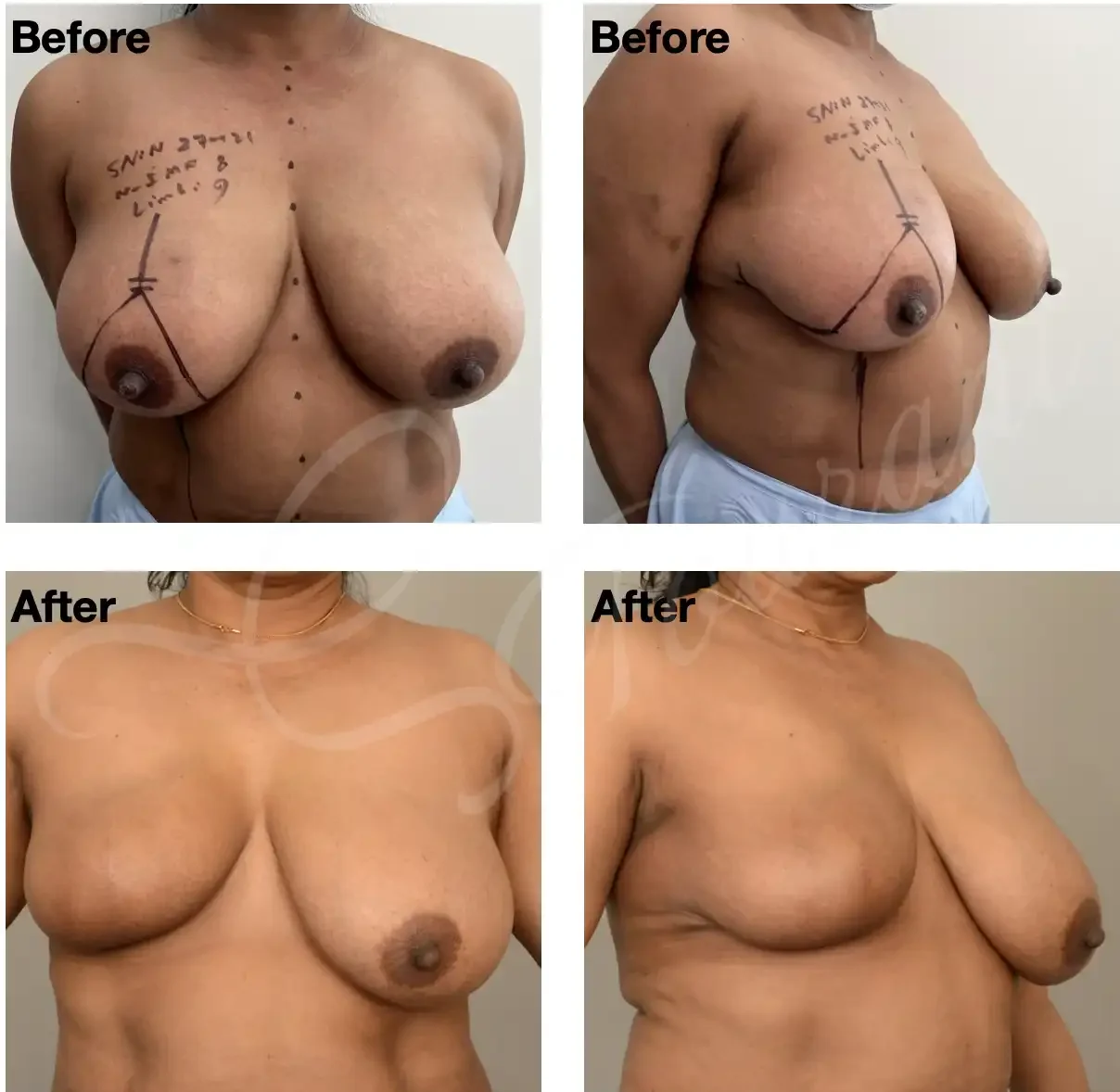 Case 104: One Year post right breast central lumpectomy + therapeutic mammoplasty for Paget’s disease of the nipple. Nipple reconstruction and symmetrising left breast reduction can be done at the same time or later. 