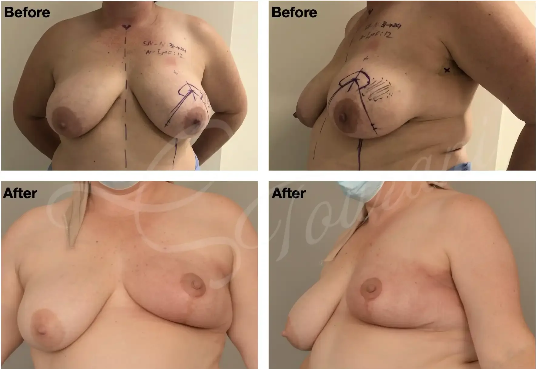Case 101: 6 months post left breast lumpectomy for a large upper outer cancer (marked) + therapeutic mammoplasty + adjuvant radiotherapy. Symmetrising right breast reduction can be performed at the same time or down the track.