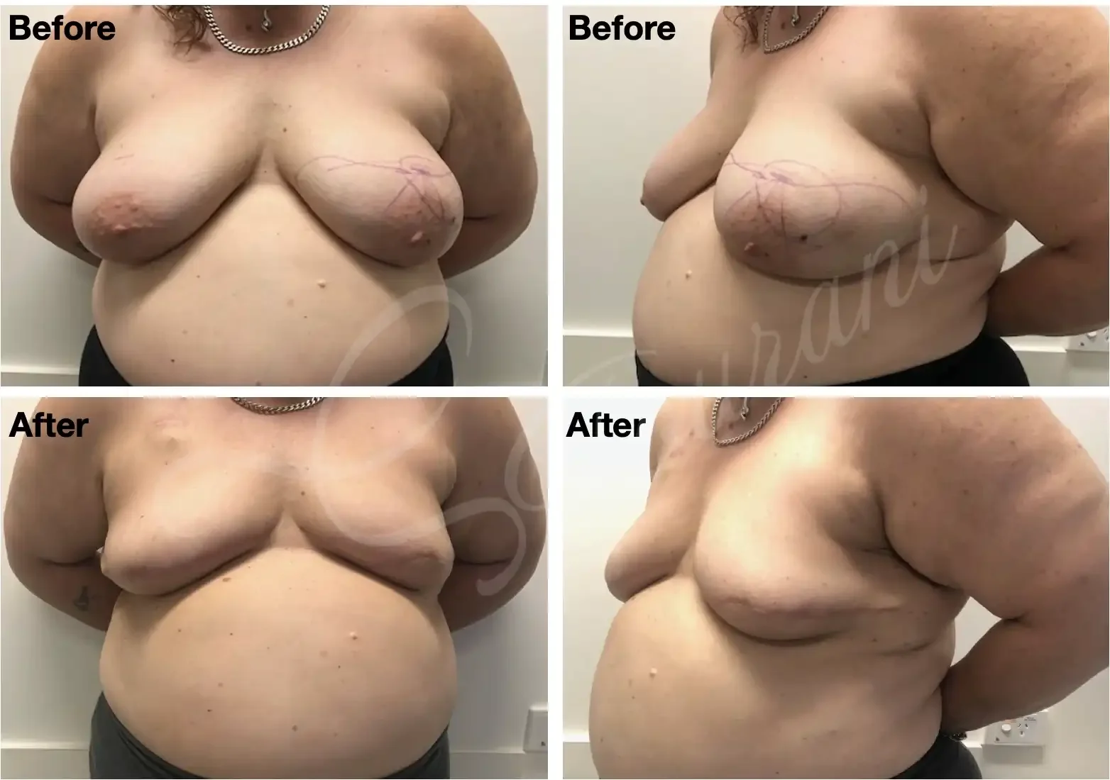 Case 110: 6 months post left breast lumpectomy for a large multicentric cancer + axillary lymph node dissection + bilateral melon slice breast reduction in a patient with multiple comorbidities.