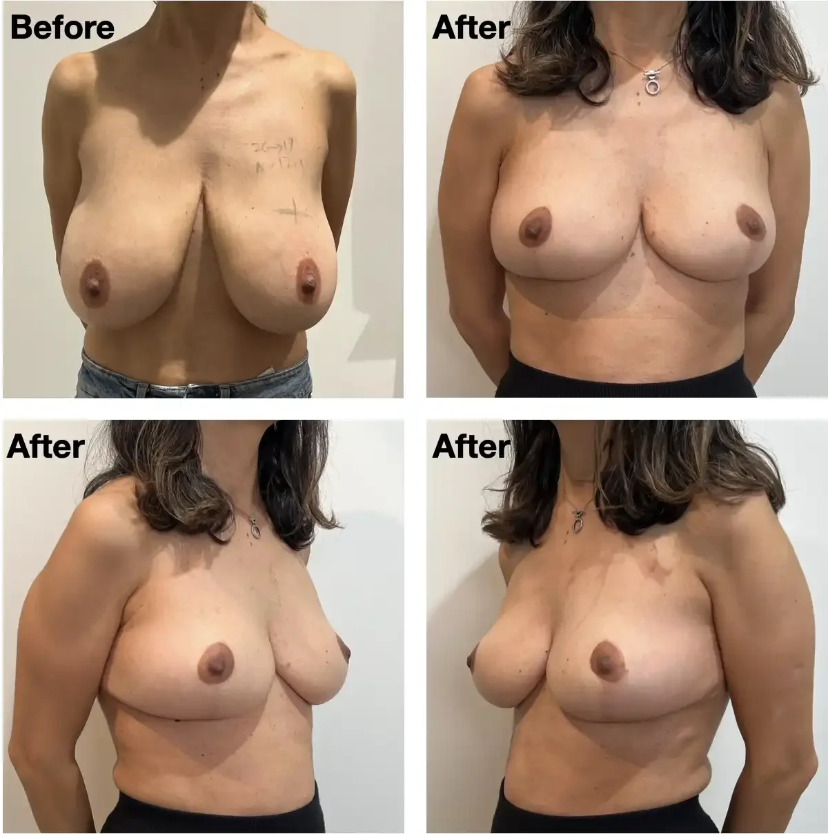 Case #209: One year post bilateral breast reduction. 