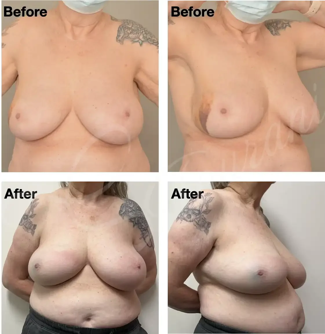 Case 114: One year post left breast lumpectomy  for a large multicentric cancer + LTAP flap