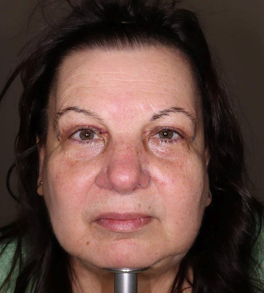 AFTER: Eyelid Conditions | Gender: Female | Age: Over 60 | Gender: Female | Ethnicity: White