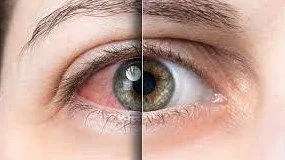 Gut Health and Vision: How our Microbiome Affects our Eyes