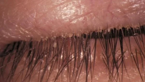 Blepharitis: An Ugly Symptom of Dry Eyes