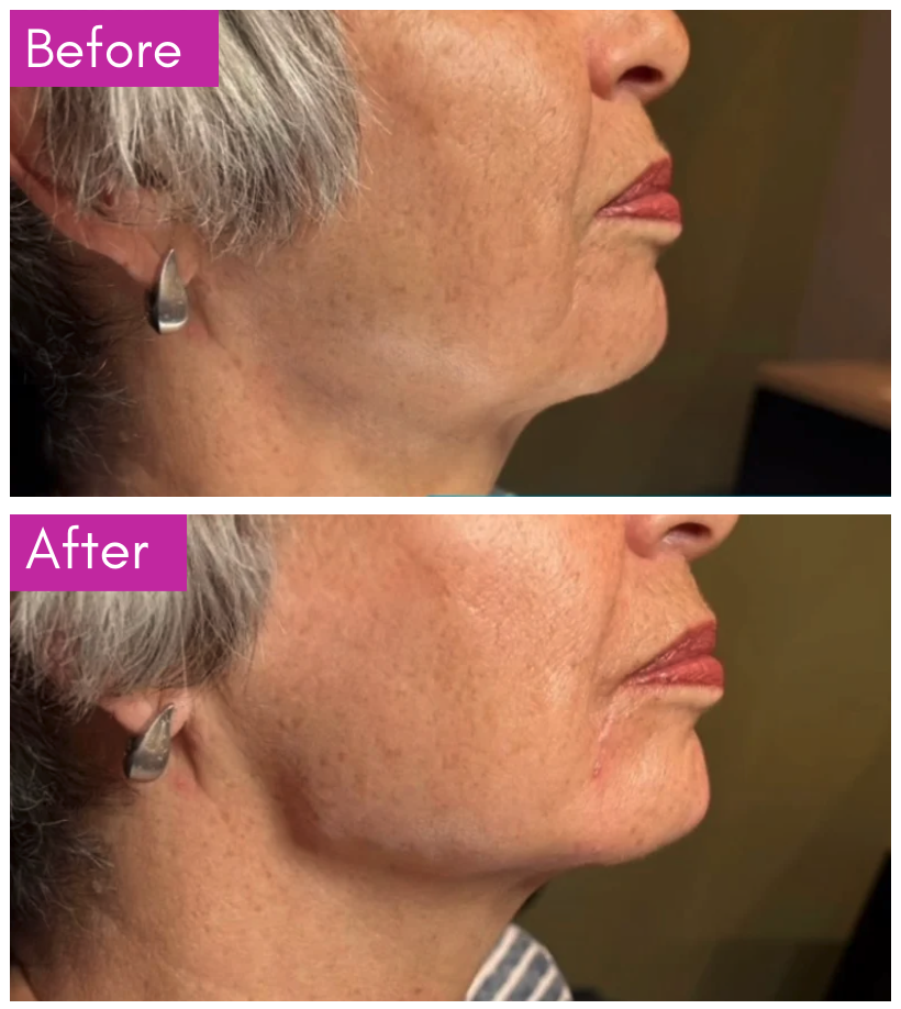 Before-and-after side profile showing improved facial volume and jawline definition.