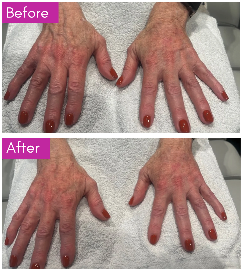 Before-and-after comparison showing improved volume and skin appearance on the backs of the hands.