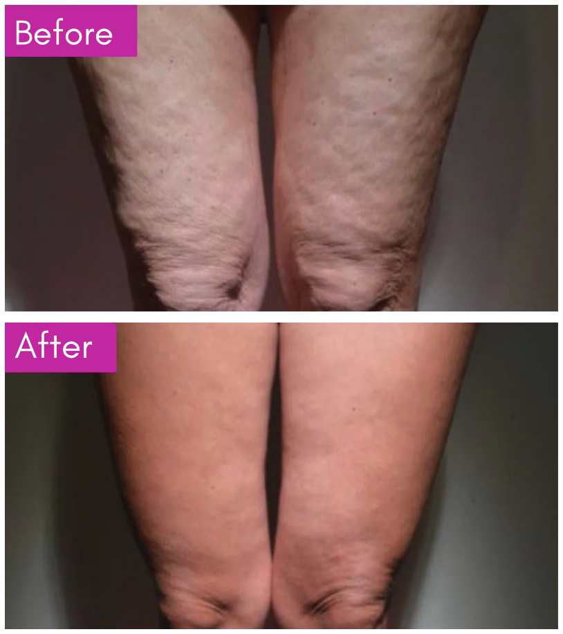 Before-and-after comparison showing improved skin firmness and texture around the knees.