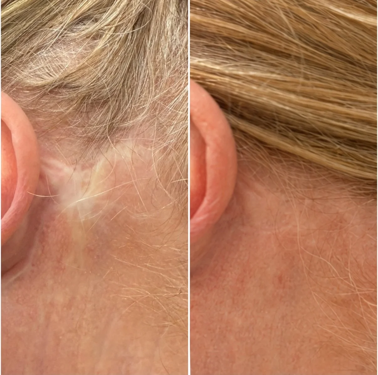 Facelift Scar - Camouflage Tattoo